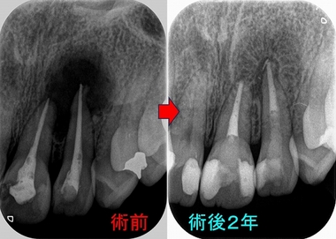 間違った根管治療で大きな根尖病変（膿） - EE DENTAL_Blog